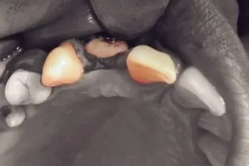 Procedimento de cirurgia da articulação temporomandibular