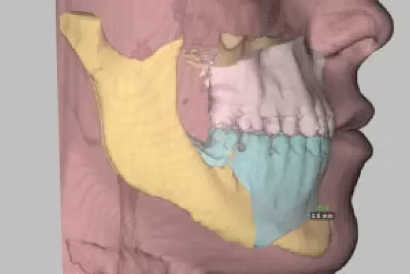 Tomografia 3D dos ossos da face